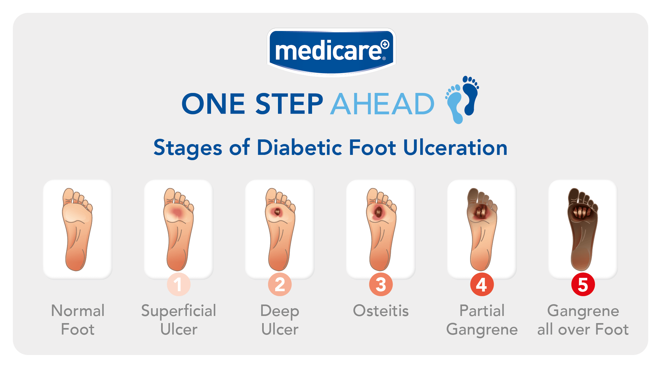 Ulcer on foot shop treatment